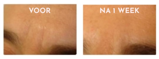 Rose of the Empress facelifting bundel