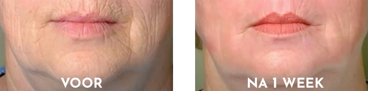 Rose of the Empress facelifting bundel